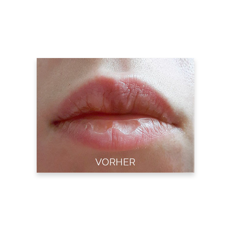 lusciouslips-lippen-vorher5a659413862a1