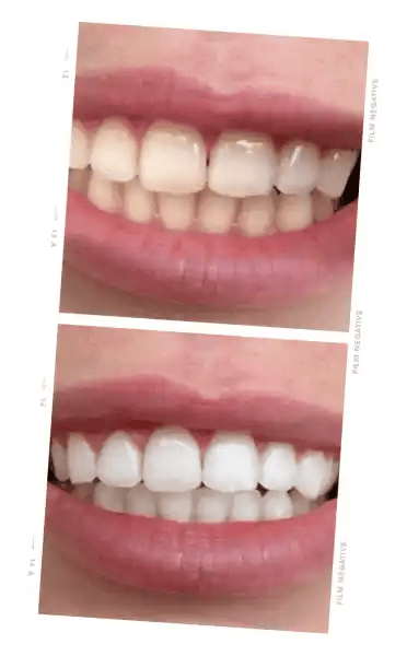 ONLYSMILE kit de blanchiment des dents