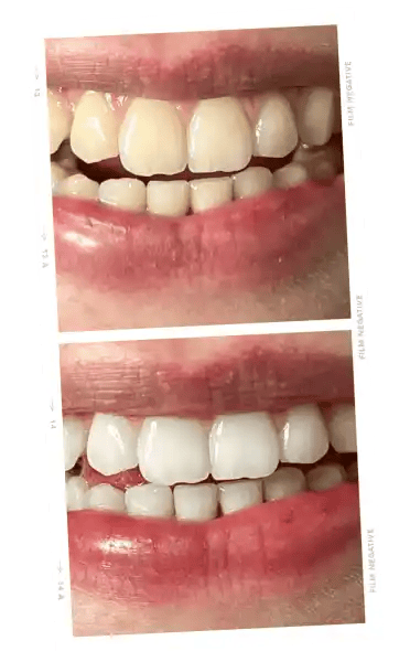 ONLYSMILE kit de blanchiment des dents