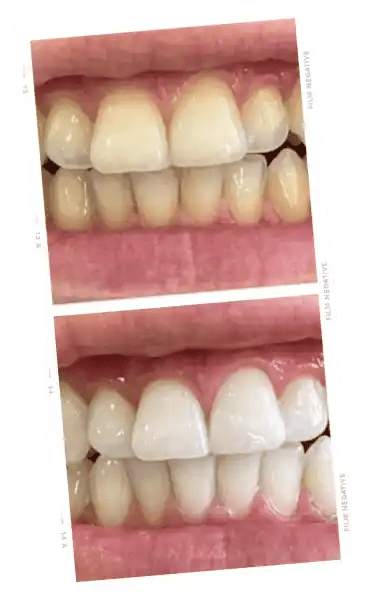 ONLYSMILE poudre pour blanchiment des dents
